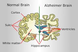 Two Types of Alzheimer's