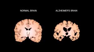 Some Alzheimer's Basics