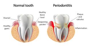 Dental Health and Parkinson’s